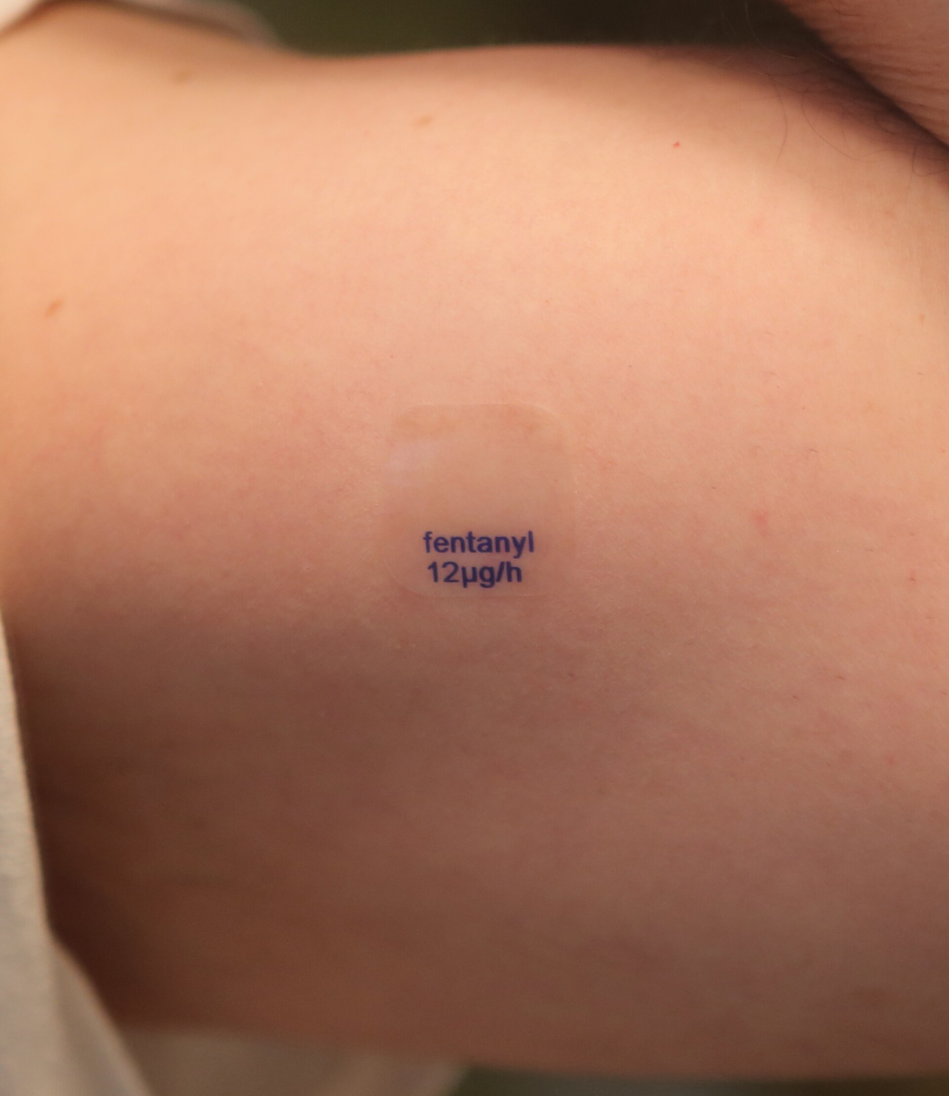 A fentanyl patch with the text 'fentanyl 12µg/h' printed in blue is adhered to a person's skin.